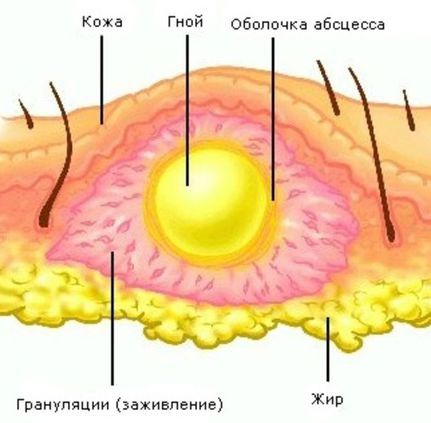 Абсцесс.jpg