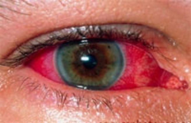 Диагноз увеит.jpg