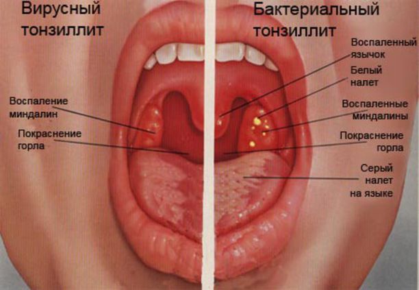 Palatine tonsils: physiology and pathology