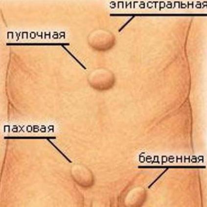 Паховая грыжа: причины, симптомы и хирургическое лечение в Москве в ФНКЦ ФМБА