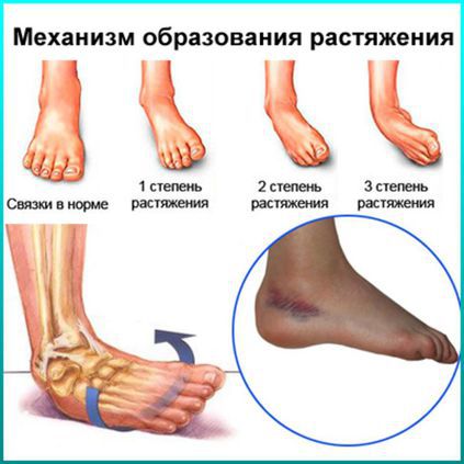 Повреждение связок коленного сустава | Институт лечения боли