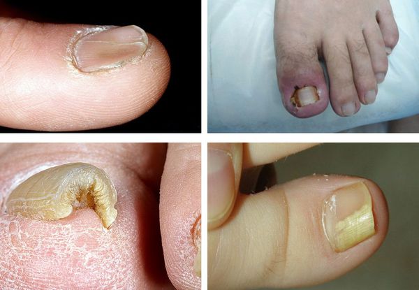 Этиология грибка на ногтях